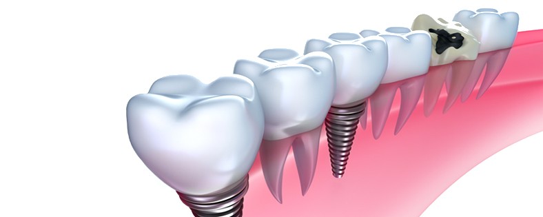 Dental_Implants